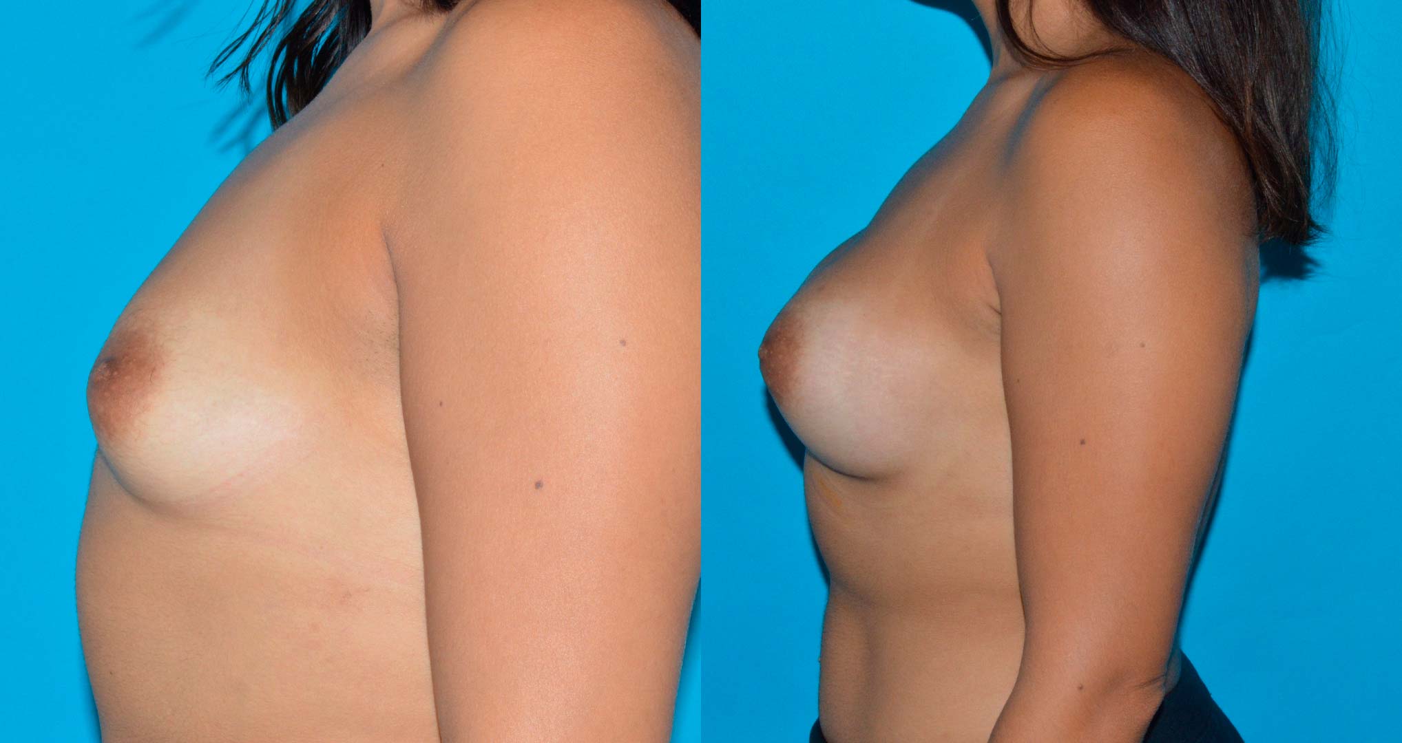 dr-valdez-reconstruction-of-tuberous-breast_thirtythree