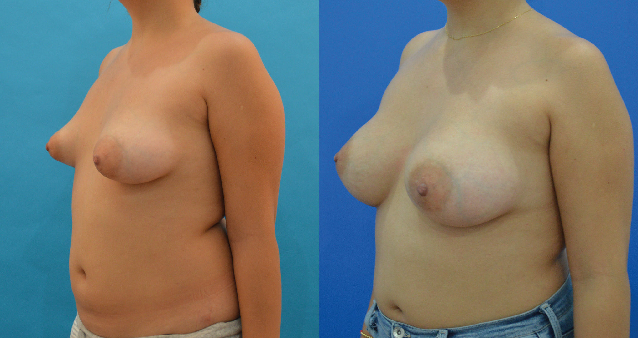 dr-valdez-reconstruction-of-tuberous-breast_three