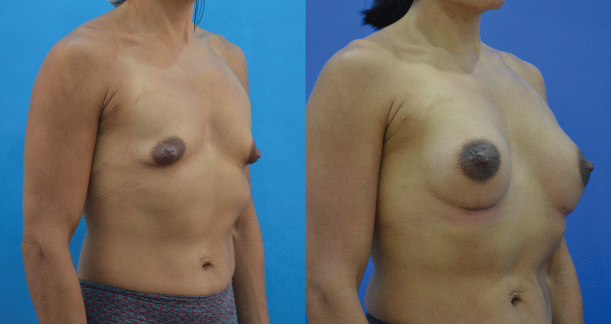 dr-valdez-reconstruction-of-tuberous-breast_twelve