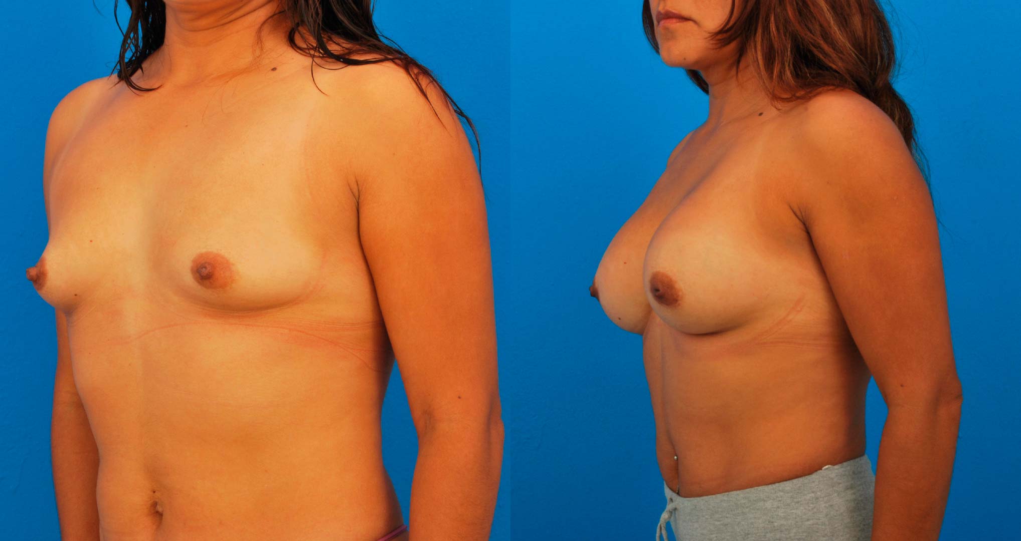 dr-valdez-reconstruction-of-tuberous-breast_twentyfour