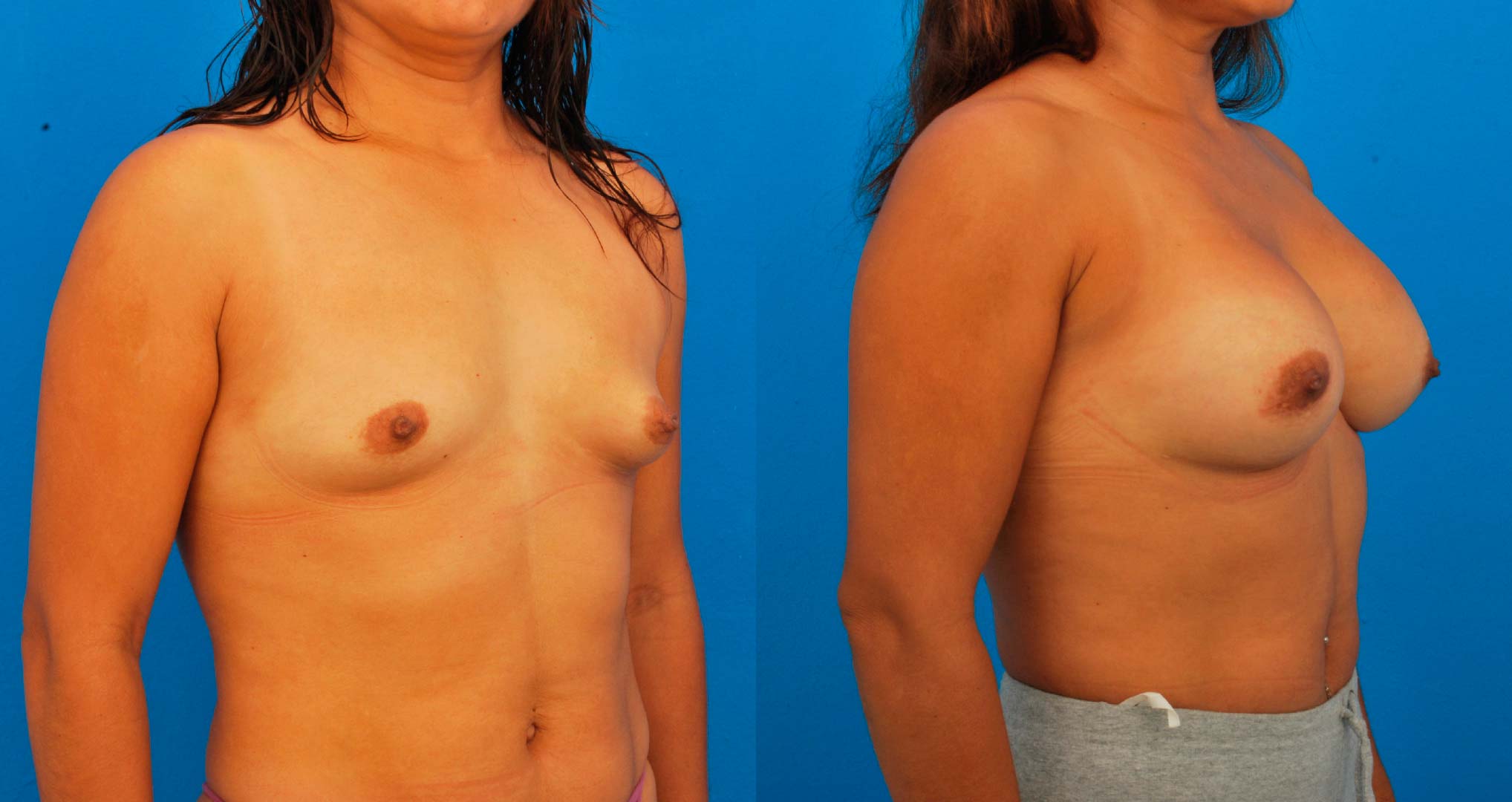 dr-valdez-reconstruction-of-tuberous-breast_twentytwo