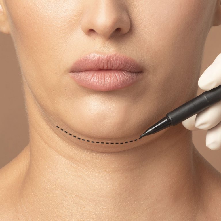 dr valdez necklift what is 768x768 1
