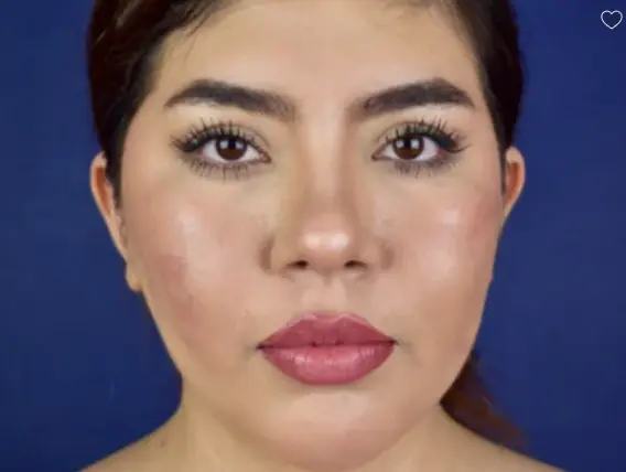 18 24 Year Old Woman Neck Lift Chin Implant Buccal Fat Removal 1