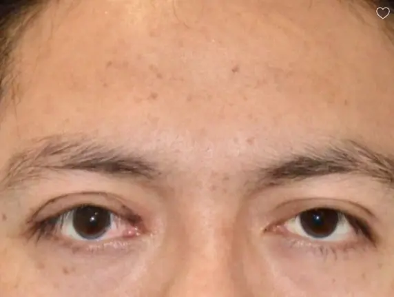 25 34 Year Old Man Blepharoplasty and Ptosis Surgery 1