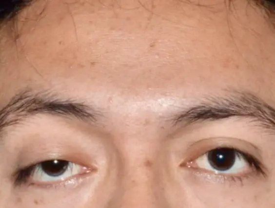 25 34 Year Old Man Blepharoplasty and Ptosis Surgery 2