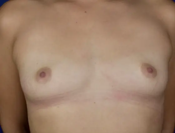 25 34 Year Old Woman Breast Augmentation 4 2