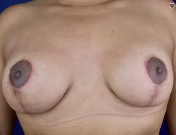 25 34 Year Old Woman Tuberous Breast Correction Breast Lift Breast Augmentation 1