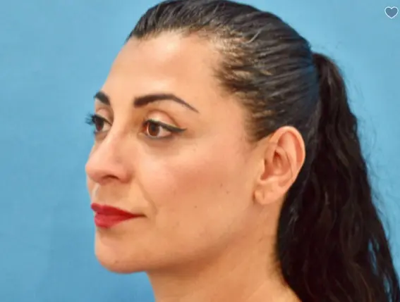 35 44 Year Old Woman Rhinoplasty Chin Implant 1