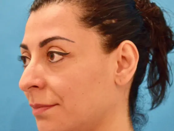 35 44 Year Old Woman Rhinoplasty Chin Implant 2