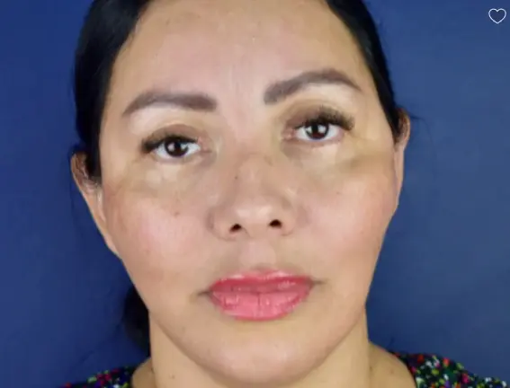 45 54 year old woman blepharoplasty deep plane facelift brow lift chin implant 1a 2 Copy