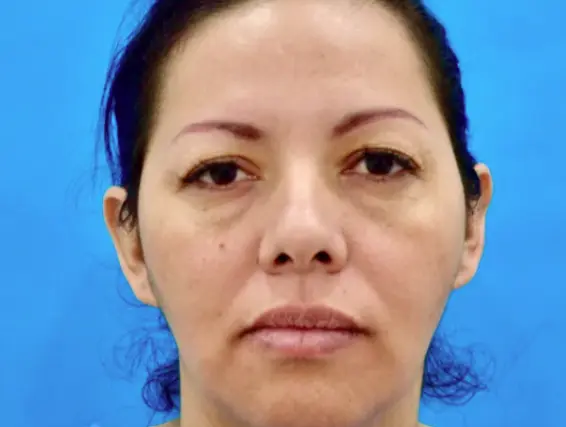 45 54 year old woman blepharoplasty deep plane facelift brow lift chin implant 1a 3 Copy