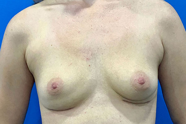 Breast Implant Removal Case 2b