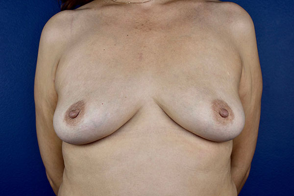 Breast Implant Removal Case 3b