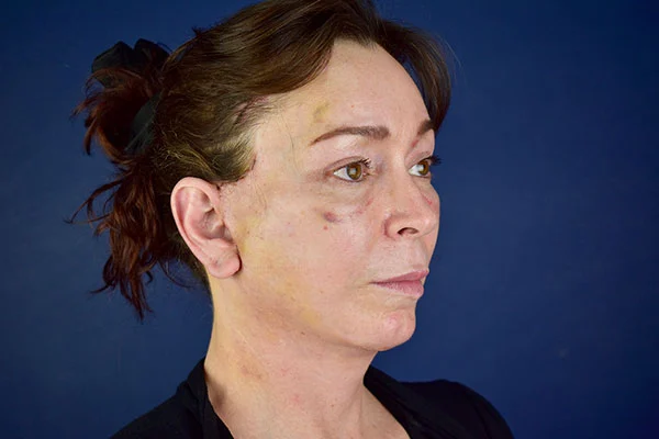 Facelift Case 1a