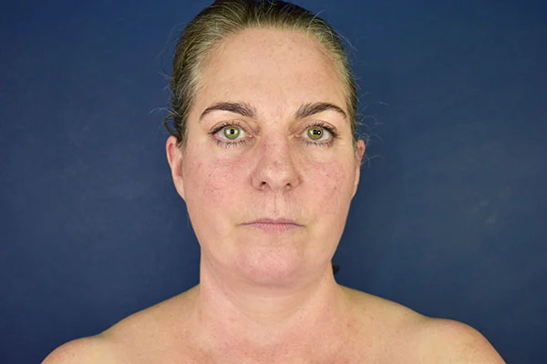 facelift case 10c