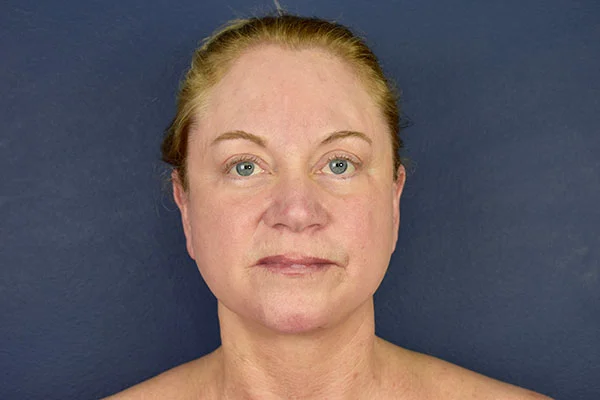 facelift case 11c