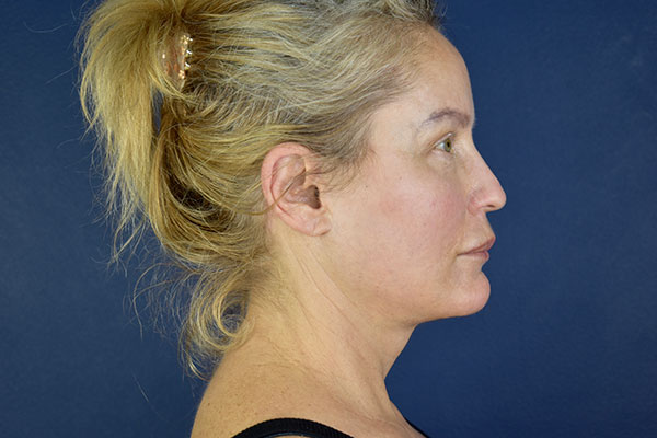 facelift case 13 c