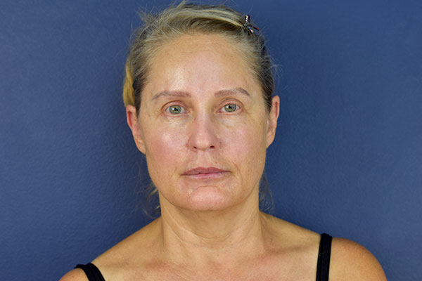 facelift case 13