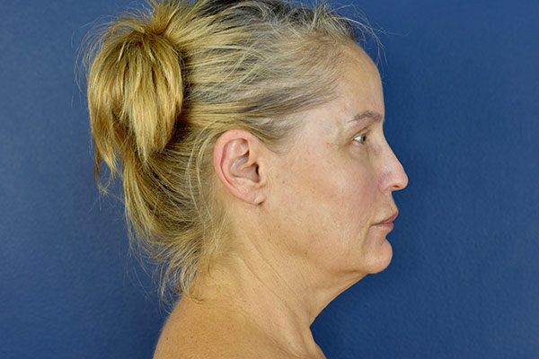 facelift case 13a