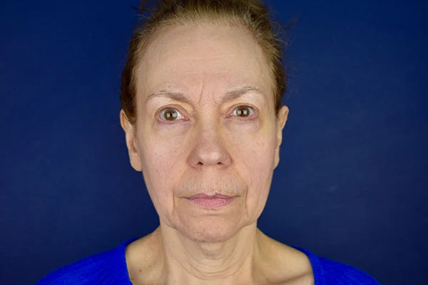 facelift case 3