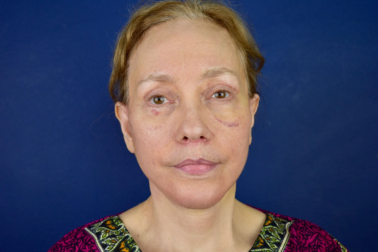 facelift case 3c
