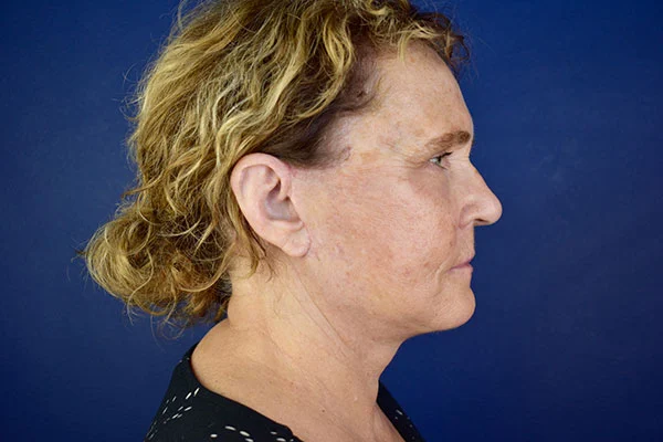 facelift case 6e