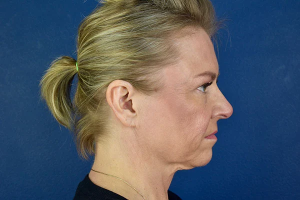 facelift case 7e