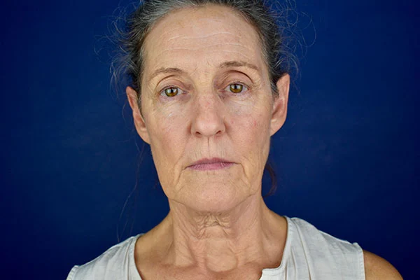 facelift case 8