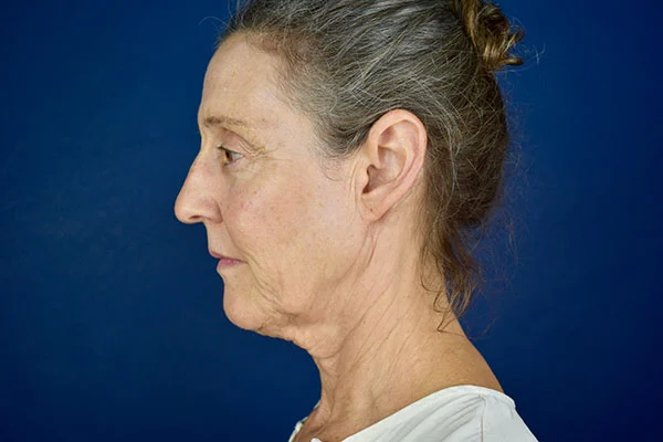 facelift case 8a