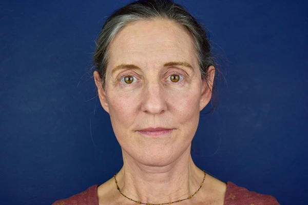 facelift case 8c