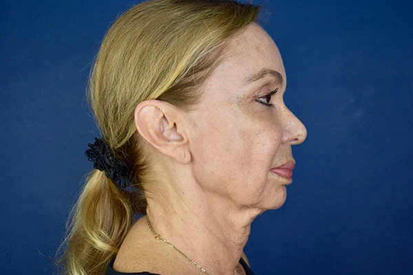 facelift case 9c