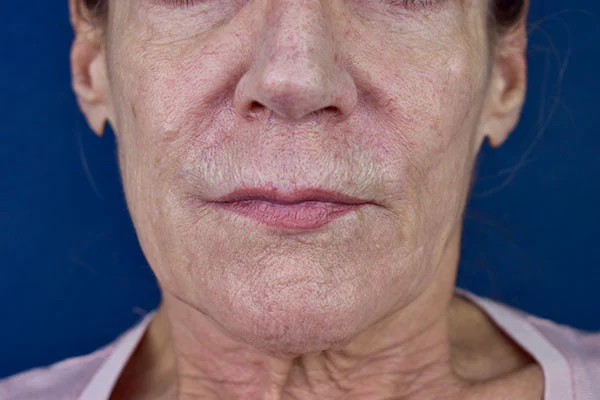 lip lift 1