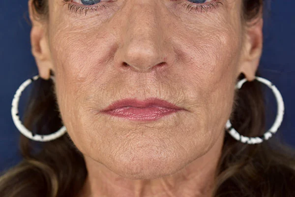 lip lift 2