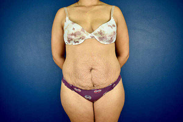 tummy tuck case 1