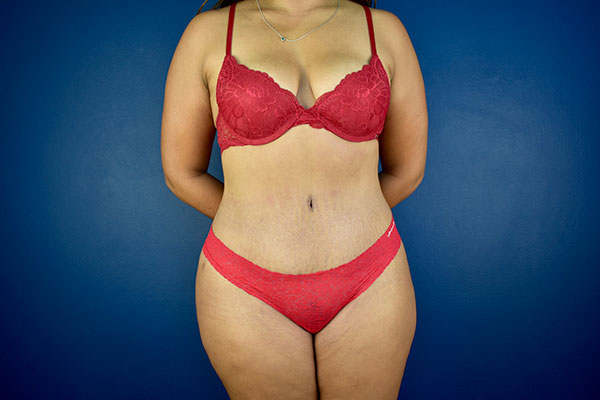 tummy tuck case 1a