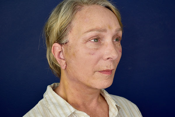 deep plan facelift necklift bleph forehead after