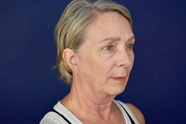 deep plan facelift necklift bleph forehead before