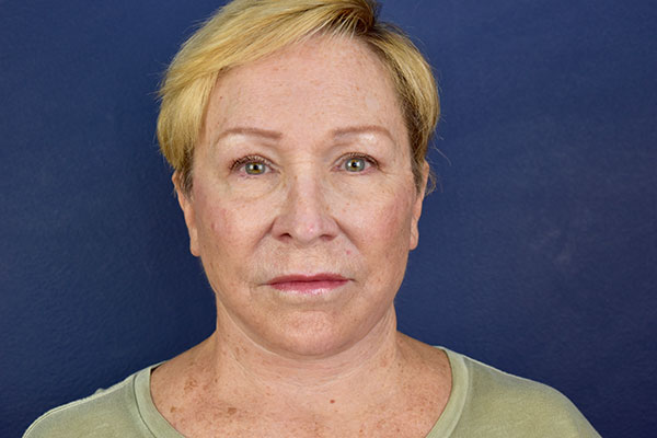 deep plane facelift neck bleph forehead after 1
