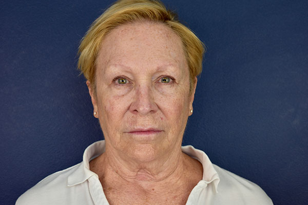 deep plane facelift neck bleph forehead before 1