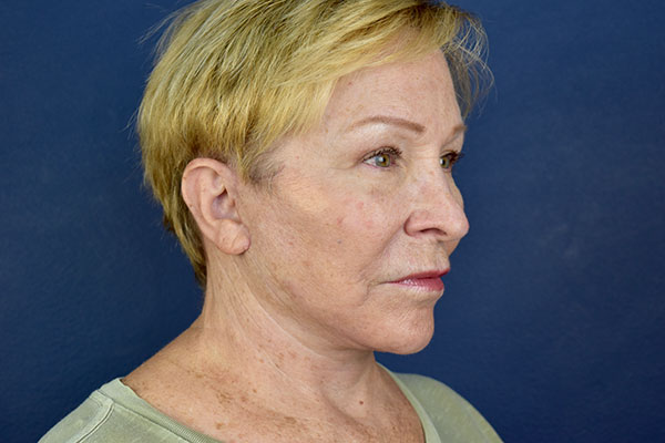 deep plane facelift neck bleph forehead before 1a