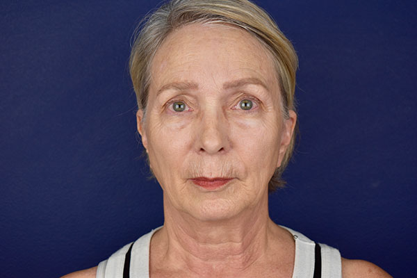 deep plane facelift neck bleph forehead before