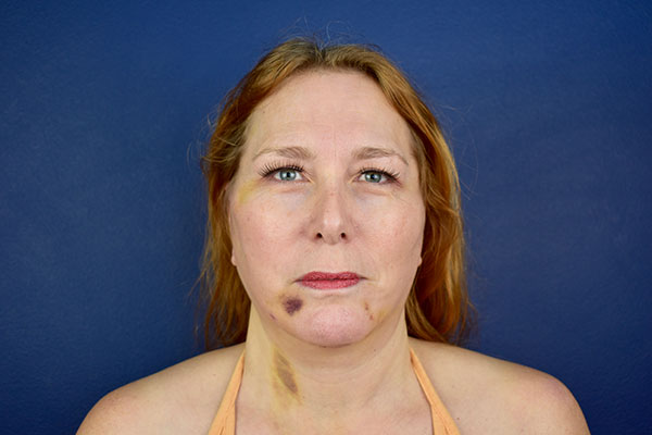 facelift necklift after 1
