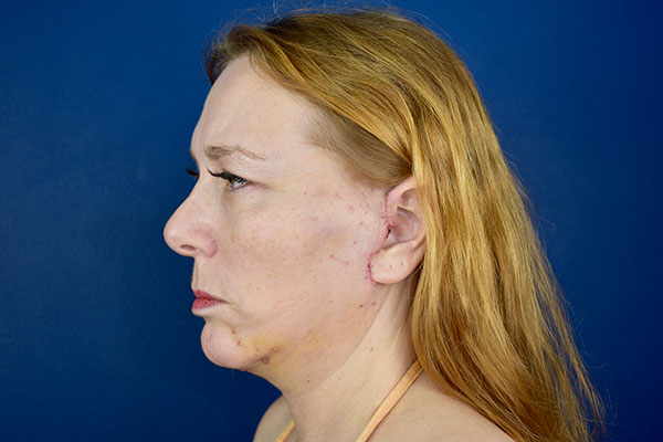 facelift necklift after 2