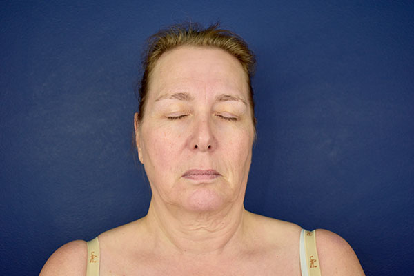 facelift necklift before 1