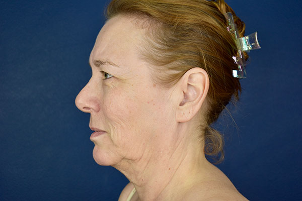 facelift necklift before 2
