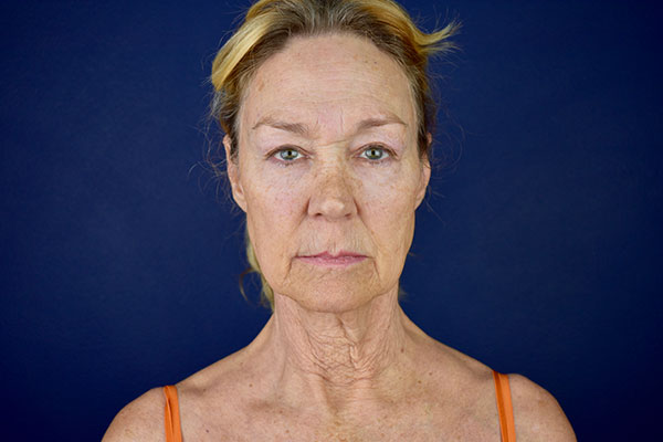 facelift necklift bleph lip lift fat transfer forehead lift before 1