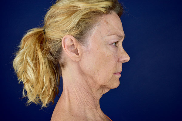 facelift necklift bleph lip lift fat transfer forehead lift before 2