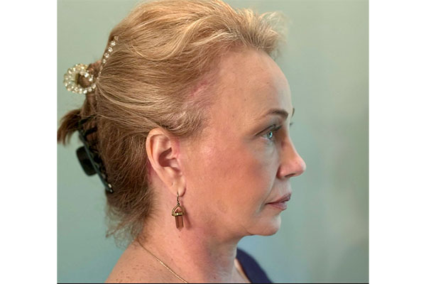 facelift necklift forehead lift after side after