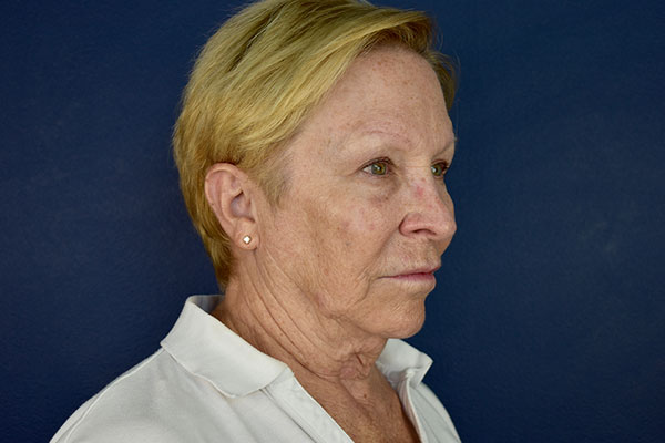 facelift necklift forehead lift after side before 1