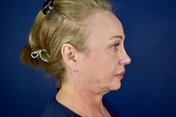 facelift necklift forehead lift after side before